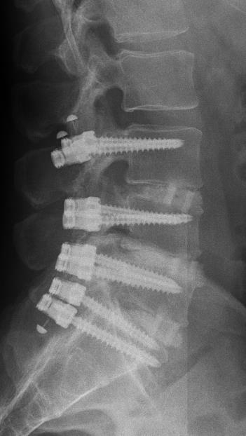 Műtét utáni röntgen kép Lukács Barna gerincéről.